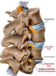 A subluxation is when one or more of the bones of your spine (vertebrae) move out of position and create pressure on, or irritate spinal nerves.